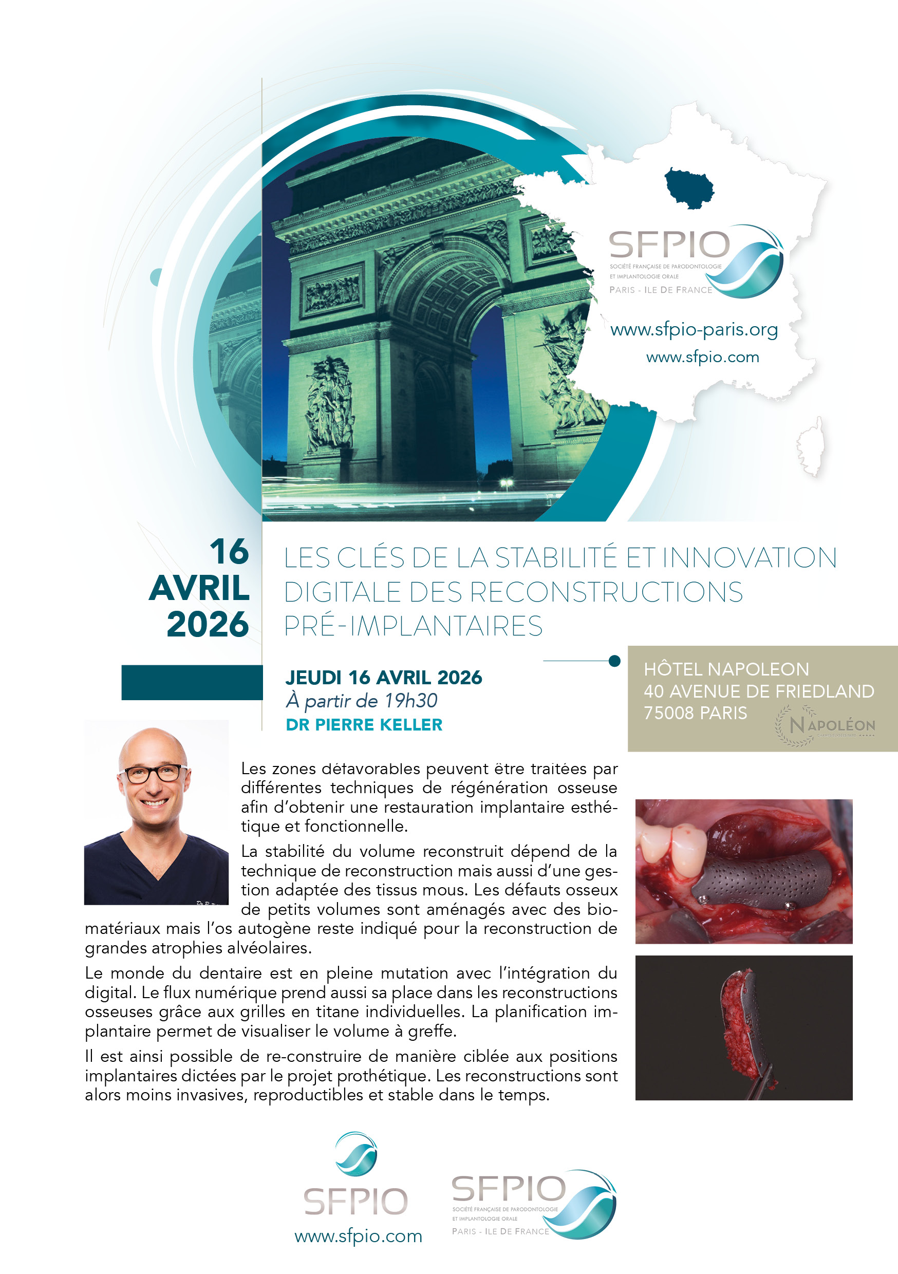 Les clés de la stabilité et innovation digitale des reconstructions pré-implantaires